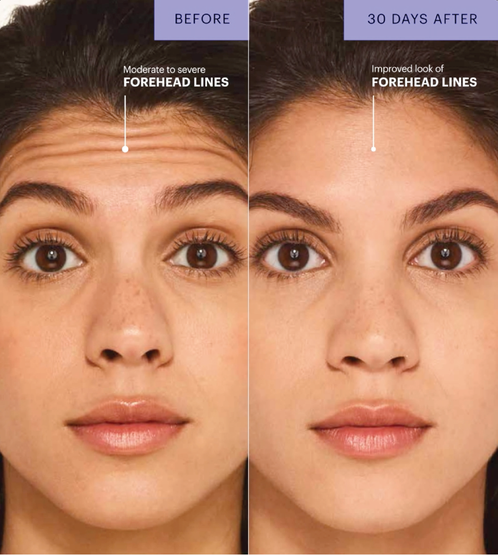 botox before + after